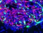 Terapia genica contro il cancro al cervello: risultati promettenti per trattamenti “mirati” contro il glioblastoma