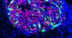 Terapia genica contro il cancro al cervello: risultati promettenti per trattamenti “mirati” contro il glioblastoma