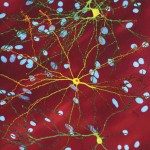 Malattia di Huntington: Abuso di sostanze e insorgenza precoce. - Immagine: Property of National Institute of Neurological Disorders and Stroke (2004-10-13). Retrieved on 14-062012