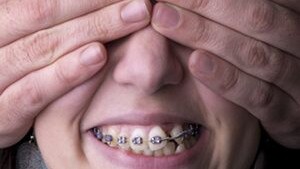 The Impact of Dental aesthetics among adolescents. -Immagine:© brunobarillari - Fotolia.com