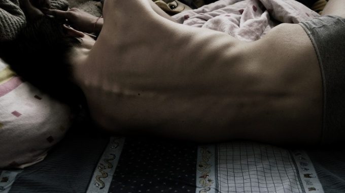 Magra, più magra, la più magra: la storia di Emma – Anoressia Nervosa