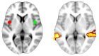 Depressione & Neuroscienze: l’imaging cerebrale per capire se la psicoterapia è stata utile