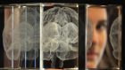 Morbo di Parkinson: la stimolazione cerebrale profonda