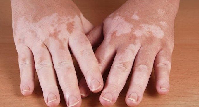 Vitiligine & qualità della vita: efficacia della psicoterapia
