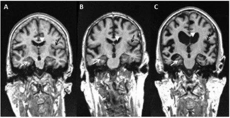 Malattia di Alzheimer il ruolo del corpo calloso nell evoluzione dei sintomi cognitivi e neuropsichiatrici _ FIG 2