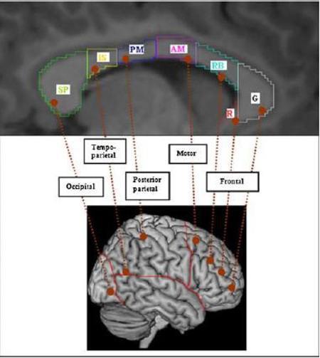 Malattia di Alzheimer il ruolo del corpo calloso nell evoluzione dei sintomi cognitivi e neuropsichiatrici _ FIG 5