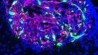 Terapia genica contro il cancro al cervello: risultati promettenti per trattamenti “mirati” contro il glioblastoma