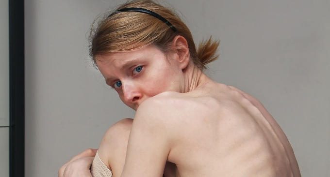 Disturbi alimentari: la motivazione al trattamento e l'intervento a domicilio