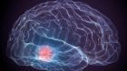 Psicoterapia e brain injury: la terapia per pazienti con danni cerebrali