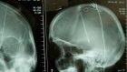 L’ascesa della tecnica della Deep Brain Stimulation (DBS) per i disturbi mentali gravi farmaco-resistenti: una questione controversa