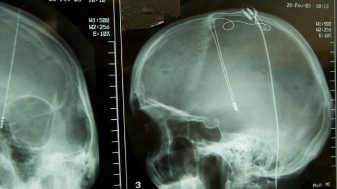 L’ascesa della tecnica della Deep Brain Stimulation (DBS) per i disturbi mentali gravi farmaco-resistenti: una questione controversa
