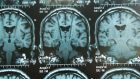 La Deep Brain Stimulation migliora le prospettive di vita per i malati di Parkinson
