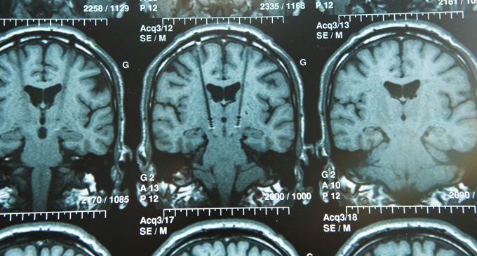 Deep brain stimulation gli effetti sulla qualità di vita nei pazienti affetti da Parkinson