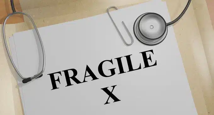 Sindrome dell' X Fragile: verso la diagnosi precoce, in età neonatale