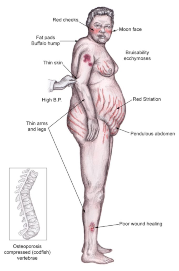 Sindrome di Cushing patologia endocrinologica e sofferenza psicologica foto
