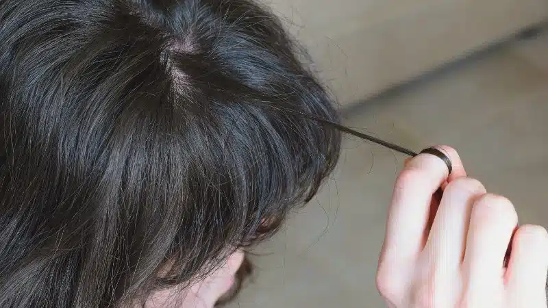 Tricotillomania caratteristiche, diagnosi e trattamento del disturbo