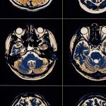 Trauma cerebrale gli effetti positivi dell inibizione del sistema immunitario