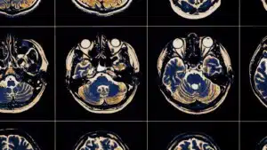 Trauma cerebrale gli effetti positivi dell inibizione del sistema immunitario