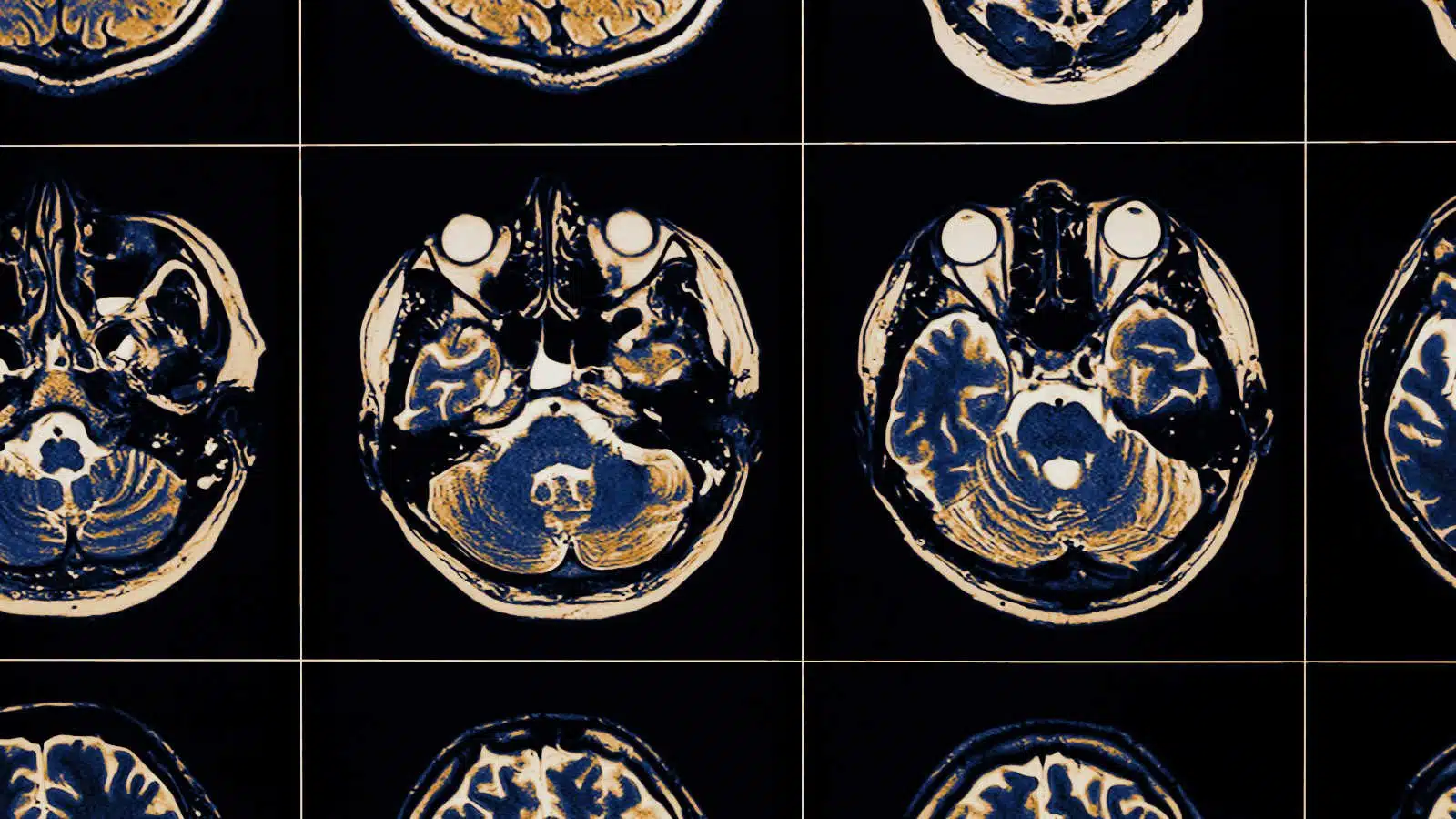 Trauma cerebrale gli effetti positivi dell inibizione del sistema immunitario