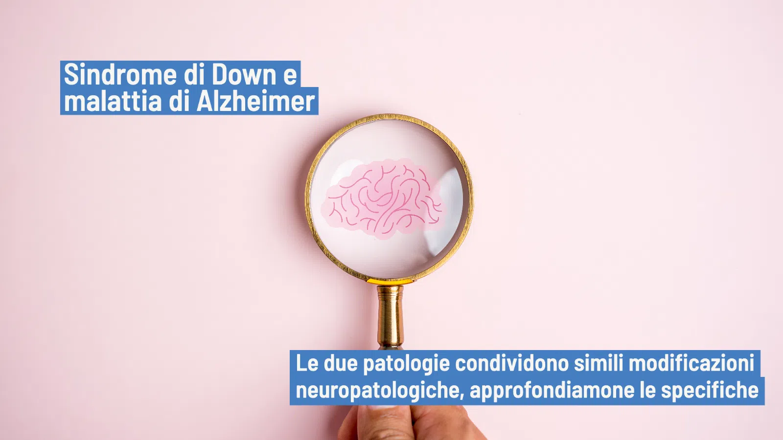 Sindrome di Down e malattia di Alzheimer: quale legame - Neuroscienze